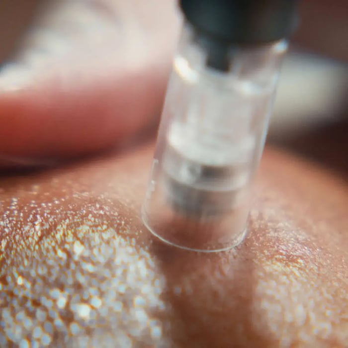 1166916357-Service-Description-Pages_Service_ProMicroneedling