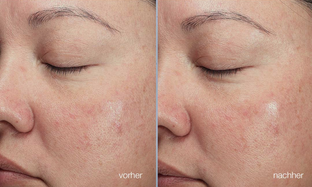 Supp Perc Claim + B&A