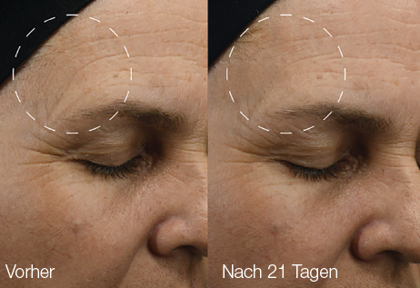 VorherNacher_ExoBooster